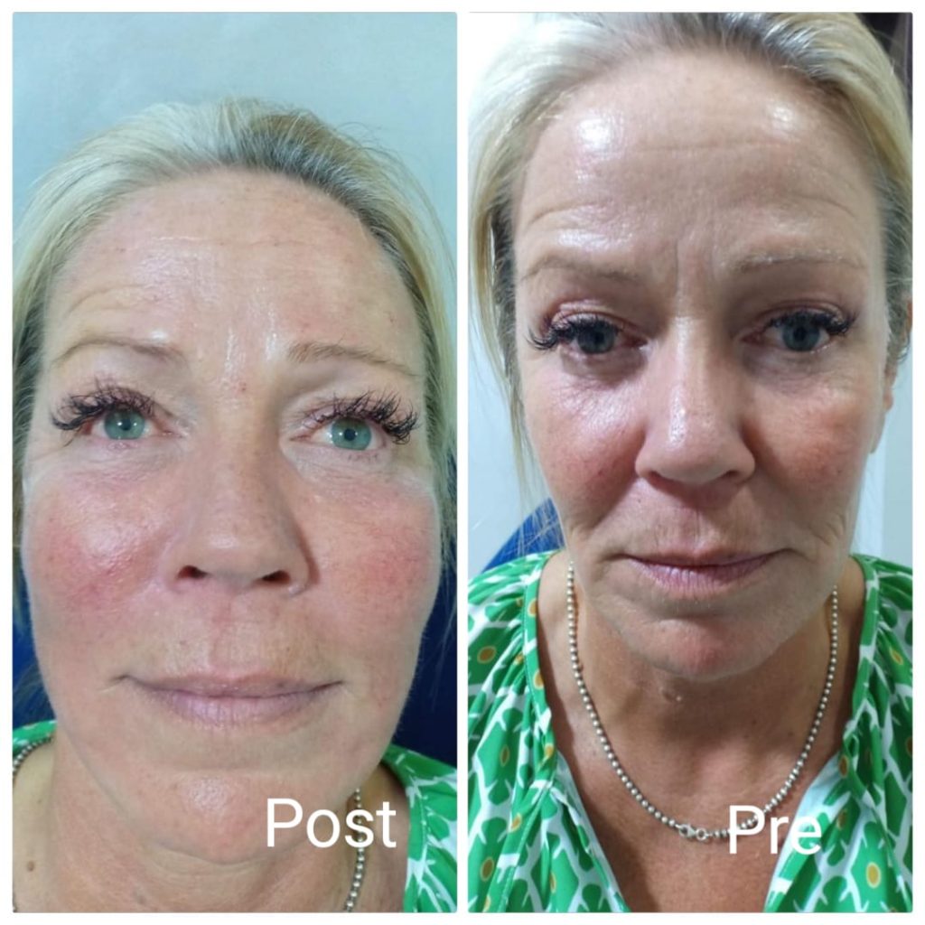 نتيجة رفع الخدود